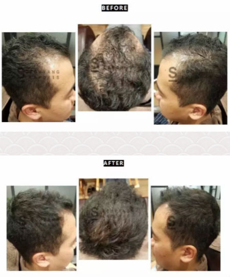 唯拾壹|別人脫單你脫發？樣的頭皮管理能讓你分分鐘開掛！