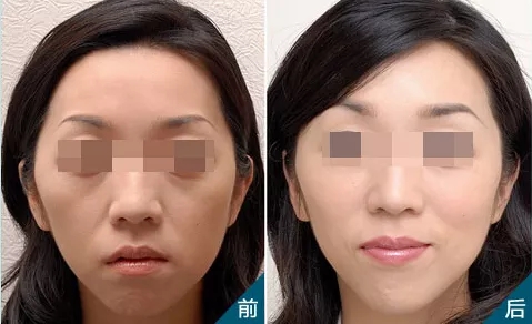 無針水光，憑什么讓女性為之瘋狂和傾倒？！