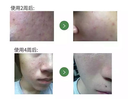 New&New|比春敏更痛苦的事...不要讓爆痘毀了你的臉！