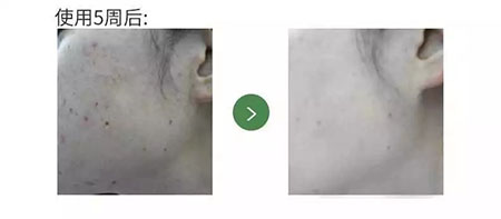 New&New|比春敏更痛苦的事...不要讓爆痘毀了你的臉！