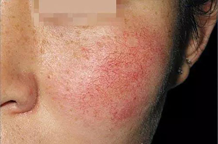 拒絕春季過敏、紅腫、發癢！敏感肌的救星來啦~