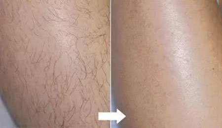 春季不脫毛，夏季獼猴桃！現(xiàn)在是脫毛的 佳時機~