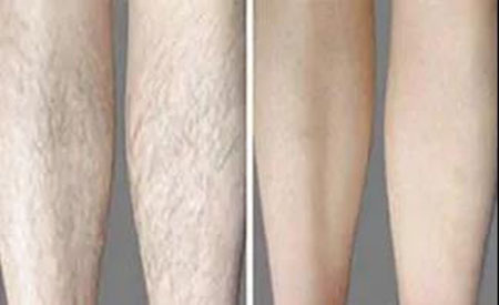 春季不脫毛，夏季獼猴桃！現(xiàn)在是脫毛的 佳時機~