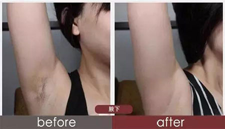 春季不脫毛，夏季獼猴桃！現(xiàn)在是脫毛的 佳時機~