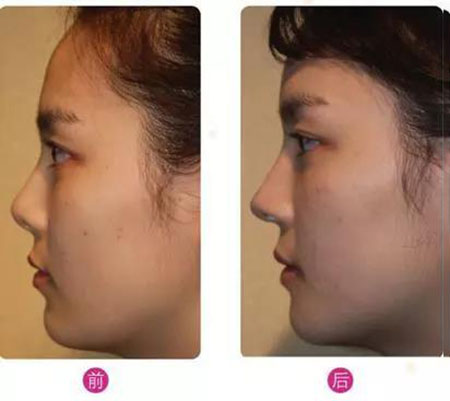 鼻綜合—點亮五官的魅力,拯救你的回頭率!