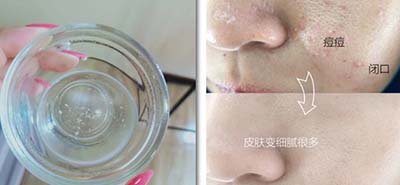 皮膚吸收不暢、粉刺痘痘不斷，是時候做下深層清潔了