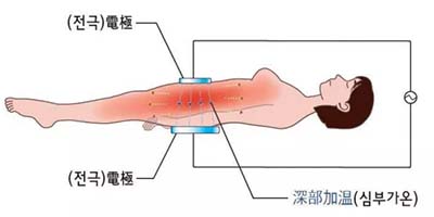 高周頻溶脂塑身管理